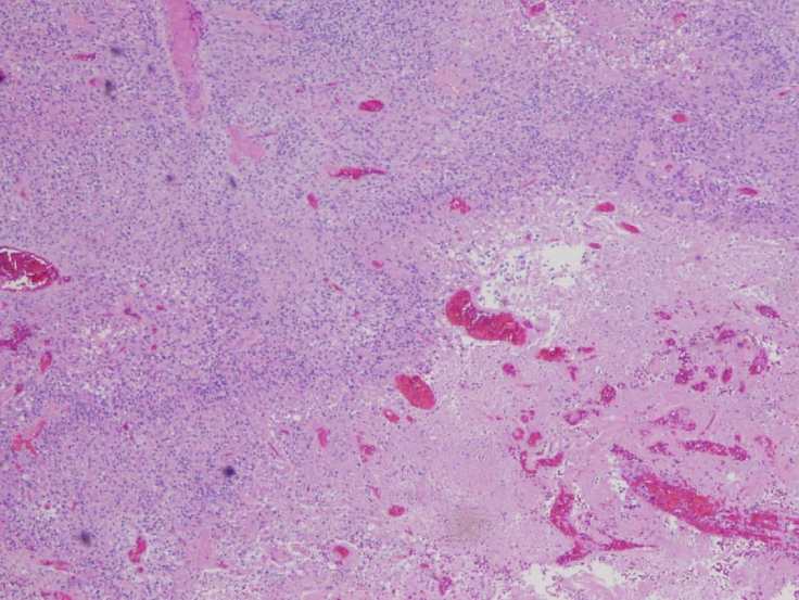 Glioblastoma with pseudopalisading necrosis