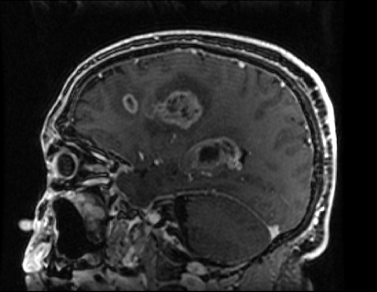 glioblastoma with ring enhancement_MRI