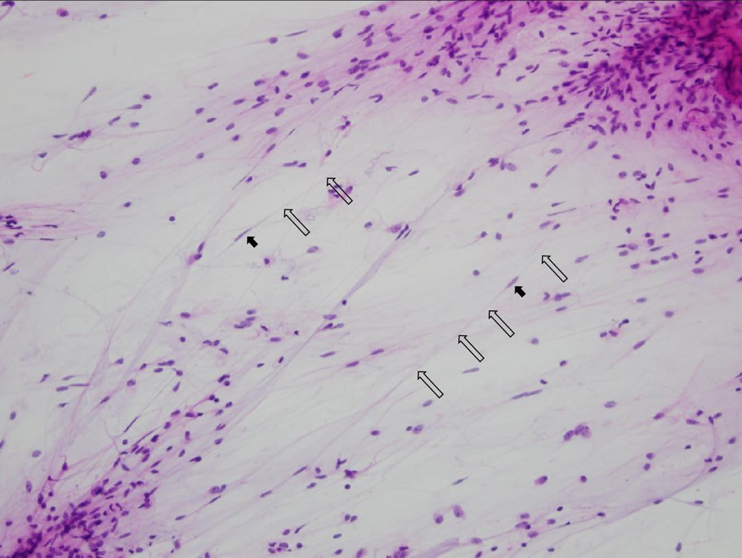 Pilocytic Astrocytoma – Adventures in Neuropathology
