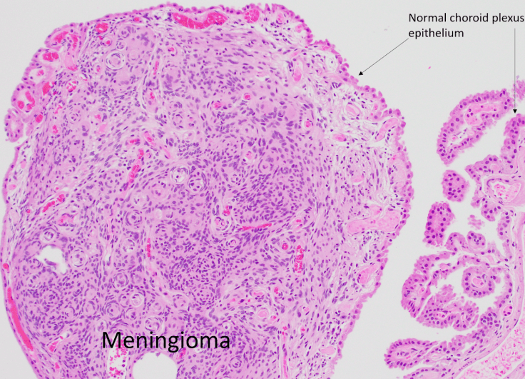 intraventricular meningioma