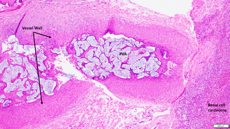 renal cell carcinoma embolized with PVA