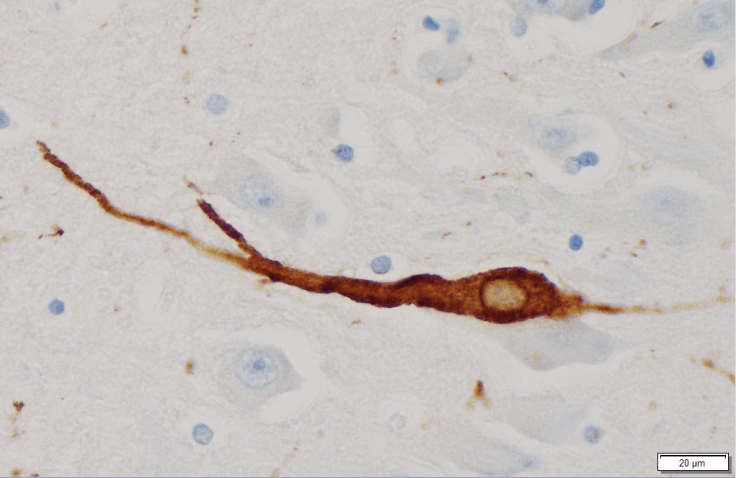 Alzheimer Disease tau-positive neurofibrillary tangles