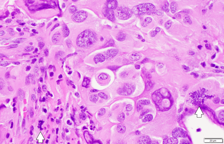 giant cell GBM and granular mitoses