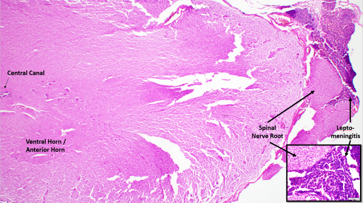 INFECTION_INFLAMMATION OF SPINE AND NERVE ROOTS