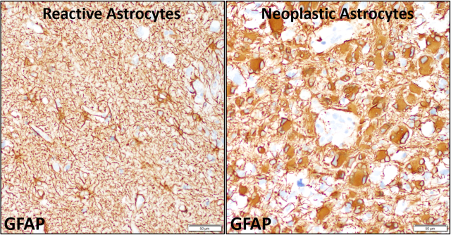 Astrocyte Histology Glial Cells: Histology And Clinical Notes | Kenhub