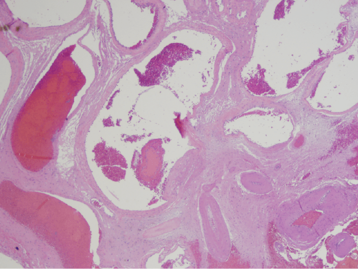 Arteriovenous Malformation