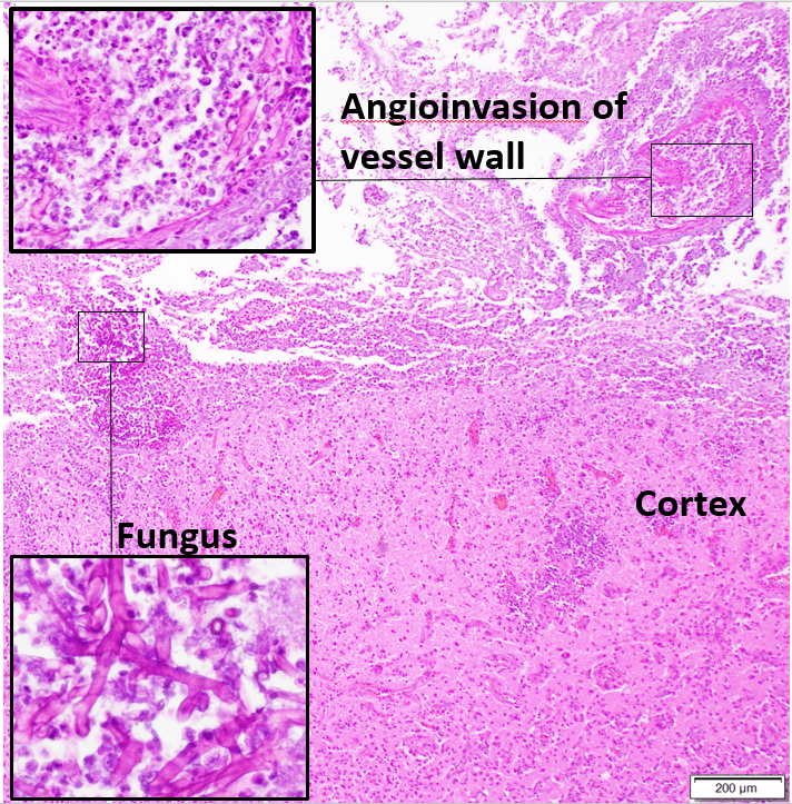 fungal encephalitis with angioinvasion