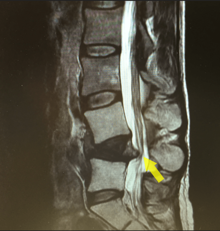 herniated disk