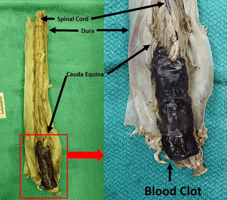 Lumbar puncture-associated spinal hematoma