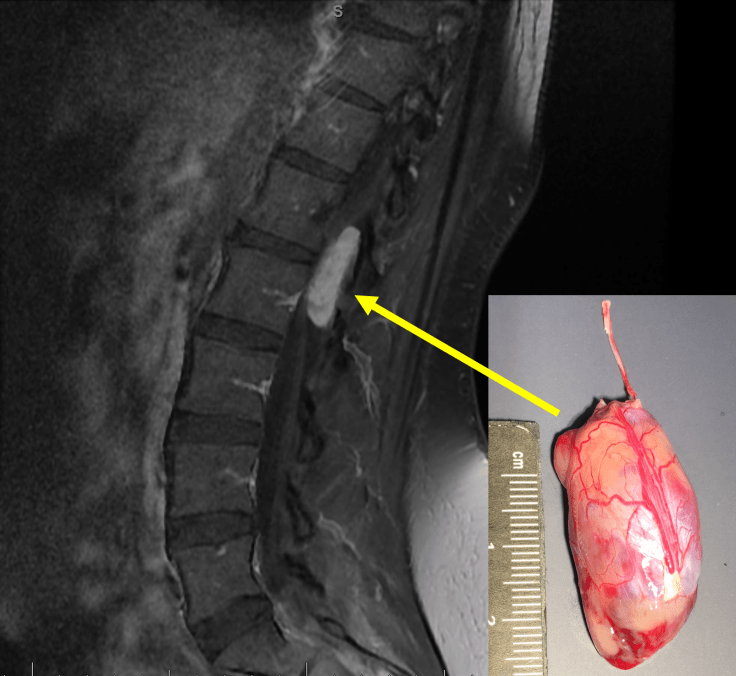 myxopapillary ependymoma_radiology-pathology correlation