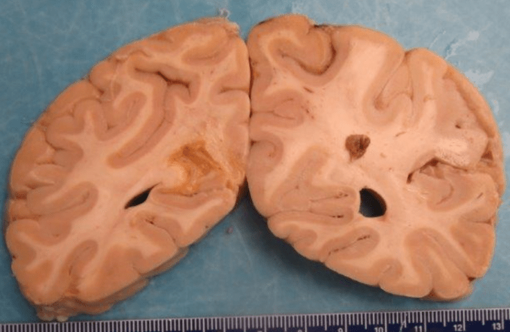 stroke_ resolving infarction