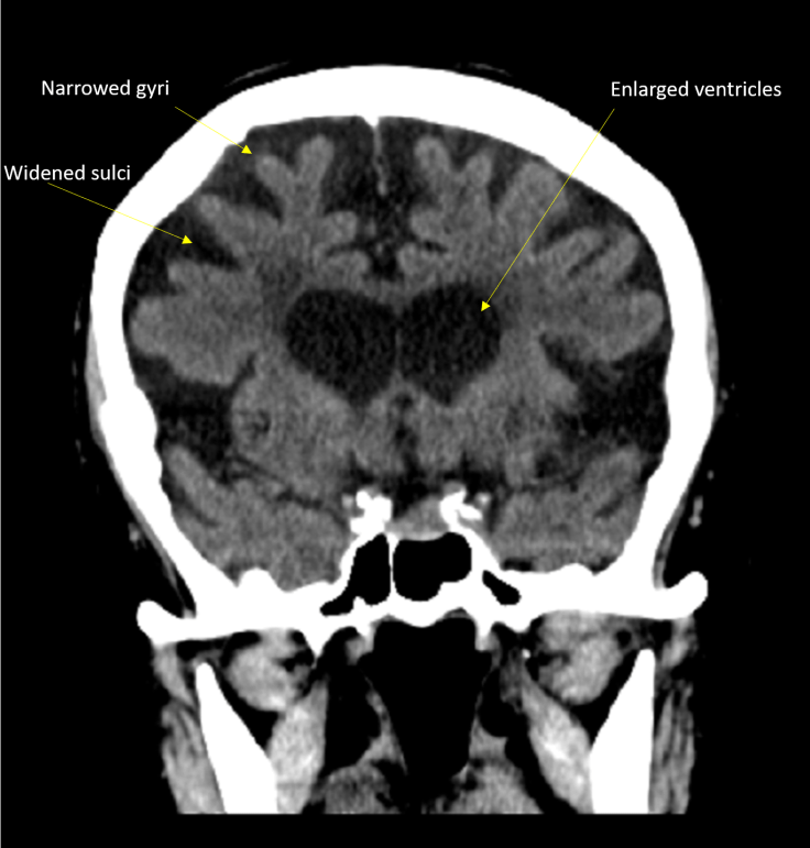 cortical atrophy