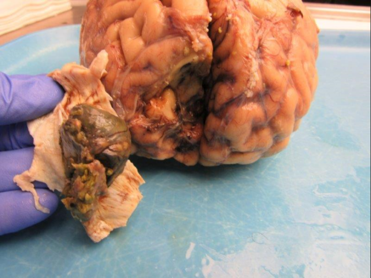 Dura Metastasis_ Hepatocellular Carcinoma