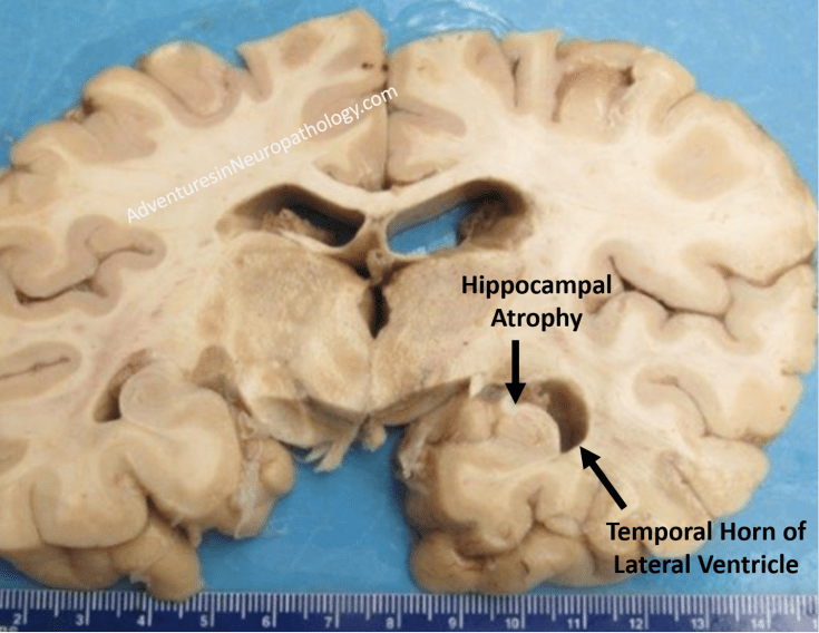 Hippocampal Atrophy
