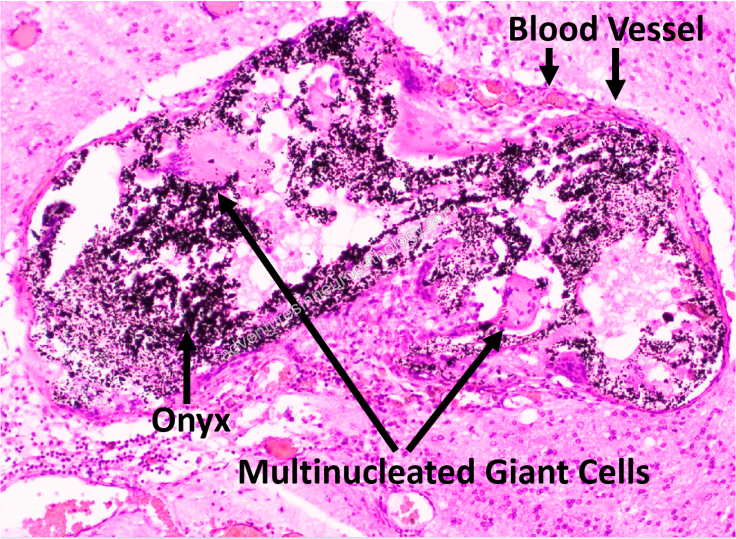 Resorption of Embolization Material in Arteriovenous Malformation (AVM)