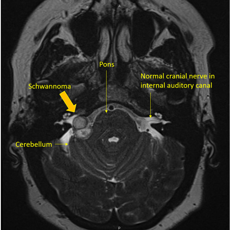 Vestibular Schwannomas
