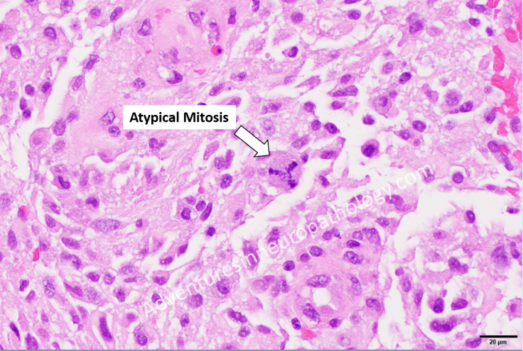 GBM with atypical mitoses