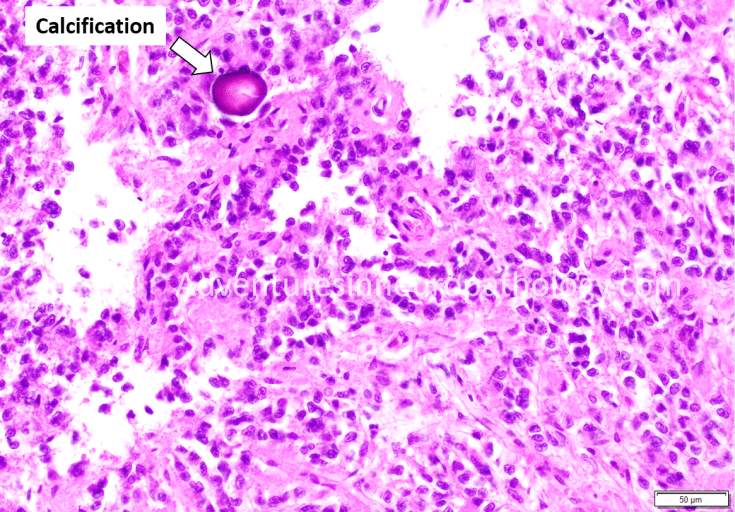 Normal Pineal gland with calcifications