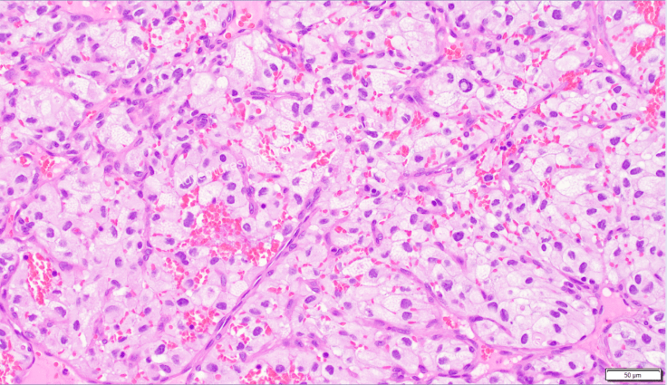 Hemangioblastoma_microscopic